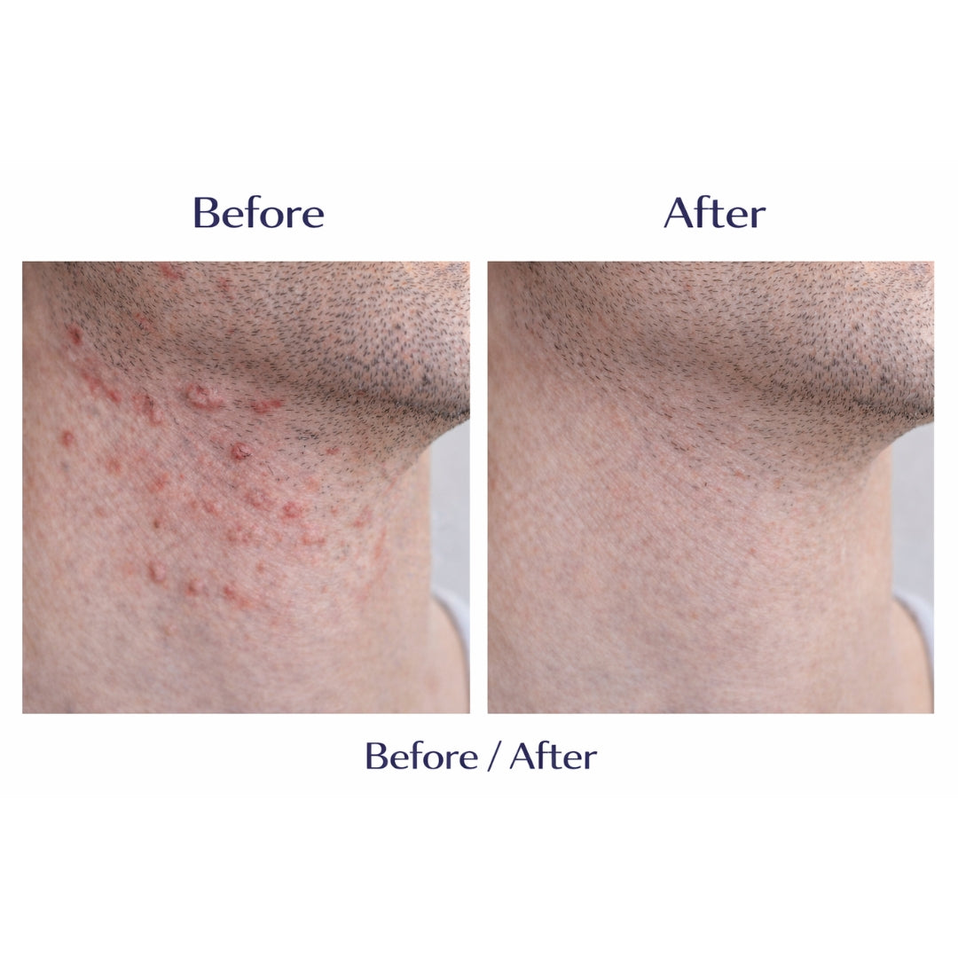 Odeon® Professional Razor Bumps Treatment Liquid – Ingrown Hair &amp; Irritation Relief (3.5 oz)