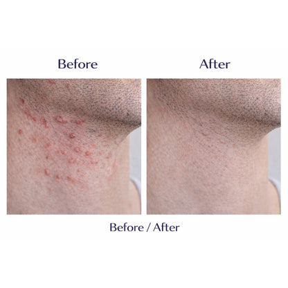 Odeon® Professional Razor Bumps Treatment Liquid – Ingrown Hair &amp; Irritation Relief (3.5 oz)