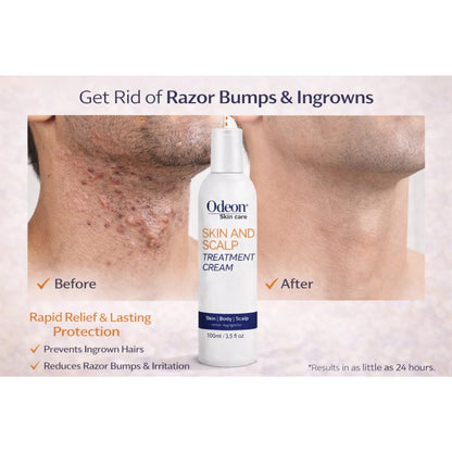 Odeon® Skin &amp; Scalp Treatment Cream – Ingrown Hair &amp; Razor Bump Solution (3.5 oz / 100ml)