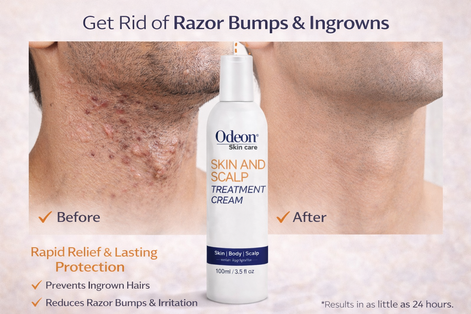 Odeon Professional Razor Bumps Care &amp; Skin and Scalp Treatment Duo – Ingrown Hair &amp; Irritation Relief (2 x 3.5 fl oz)